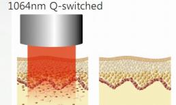 Trị nám vĩnh viễn với công nghệ đỉnh cao