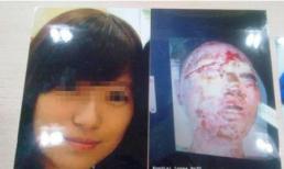 Nữ sinh bị người yêu cũ tạt axit kinh hoàng