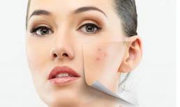 “Xóa sổ” mụn tận gốc, tự tin đón xuân sang