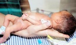 BV Phụ sản Hà Nội: bé sinh mổ bị gãy tay, chân do mắc bệnh xương thủy tinh?