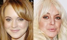 Mỹ nhân thế giới hóa thiên nga hay vịt bầu sau khi bơm botox?