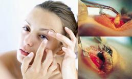 "Sốc" vì ấu trùng phát triển trong mắt người do đeo kính áp tròng