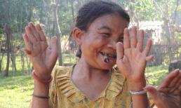 Gia đình 4 người có 104 ngón tay, chân