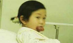 Bé 3 tuổi có lưỡi khổng lồ