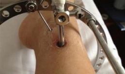 Hãi hùng với cảnh bắt vít để kéo dài chân