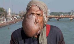 Biến dạng gương mặt vì khối u khổng lồ