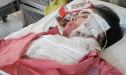 Nữ công nhân bị tạt axit phỏng mặt, cháy ngực