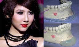 Cận cảnh phẫu thuật độn cằm