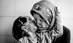 Bộ ảnh mẹ con bị tạt axit gây chấn động thế giới