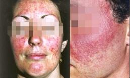 Choáng váng với hình ảnh đáng sợ sau tẩy trắng da