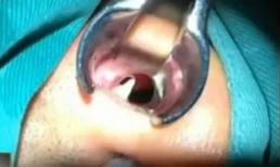 Oái oăm răng mọc... trong mũi