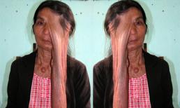 40 năm mang khối u như giọt lệ khổng lồ