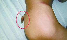 Chàng trai mọc đuôi ở mông