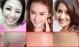 Những làn da 'lởm chởm' mụn, nám của mỹ nhân Việt (P3)