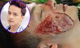 "Hoảng hồn" trước gương mặt "nát" vì tai nạn của Cao Thái Sơn