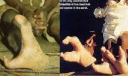 Kỳ lạ: Cả bộ lạc chỉ có 2 ngón chân như "càng tôm"