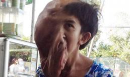 Nỗi đau người con gái 'quỷ đầu to, một mắt'