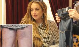 Lindsay Lohan lộ chân bầm tím đáng sợ