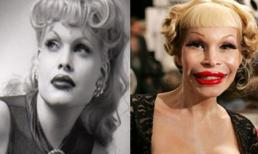 Những thảm họa phẫu thuật thẩm mỹ của sao US/UK