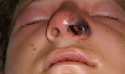 Kinh hãi cảnh vi khuẩn ăn thịt người tấn công mũi cậu thanh niên