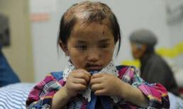 Bố dội nước sôi lên đầu, khâu miệng con gái