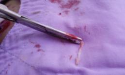 Mê ăn gỏi cá sống, một phụ nữ có sán... ở đùi