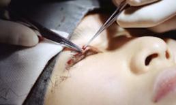 Cận cảnh PTTM: Cắt mí theo phong cách Hàn Quốc