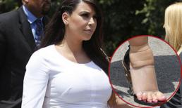 Kim "siêu vòng ba" khoe chân sưng phù như "bó giò"