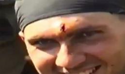 Bị đạn bắn vào đầu vẫn sống sót, gắp đạn ra bằng kìm