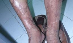 Vi khuẩn 'ăn thịt người' xuất hiện ở Việt Nam từ 2009