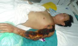 Phòng vi khuẩn ăn thịt người bằng cách nào?