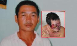 Rước họa do thuốc tẩy nốt ruồi