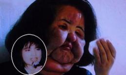 "Thảm họa thẩm mỹ Hàn" tự tiêm dầu ăn vào mặt sau khi bị từ chối phẫu thuật