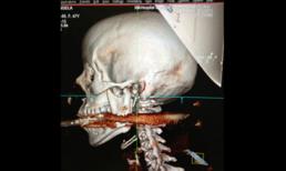 Sống sót kỳ diệu khi bị cây lao bắn thủng đầu