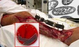 Cận cảnh vi khuẩn ăn thịt người ‘ngấu nghiến’ tế bào