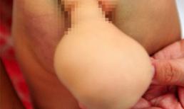 Kỳ lạ bé trai 7 tháng tuổi mọc đuôi ở Trung Quốc