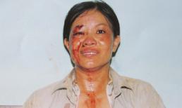 Chồng đánh vợ trọng thương phải nhập viện