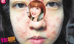 Mặt thành “bánh đa nướng” vì tham làm đẹp miễn phí