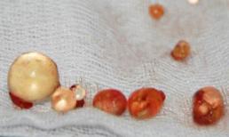 Bi hài những thanh niên tự nâng cấp 'súng' bằng silicon