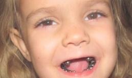 Những người có hàm răng kinh dị