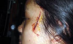 Rạch mặt cướp iPhone 5 ở Hà Nội