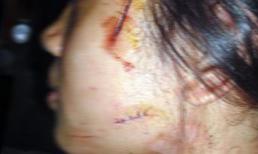 Hành trình bắt nóng kẻ rạch mặt cô gái, cướp iPhone