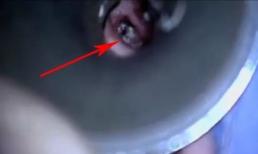 Kinh hoàng giòi làm tổ trong ống tai cô gái trẻ