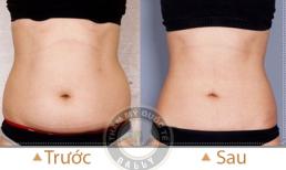 Liposonix - Công nghệ cao cấp Hoa Kỳ giảm béo 1 lần duy nhất