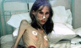 Nhịn ăn suốt 20 năm, phụ nữ 30 thành bà già 70