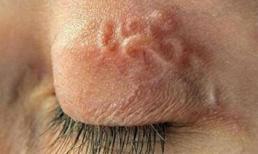 Giun lươn bò lổm ngổm dưới da: Bệnh nguy hiểm chết người!