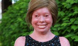 Cảm thương cô gái mắc bệnh lạ về da, có gương mặt như chú hề