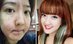 Blogger hot nhất Singapore bị hỏng da mặt vì làm đẹp