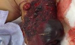 Kỷ lục truyền 46 lít máu cứu sống người bị rắn lục cắn