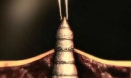 Người phụ nữ bị 14 con giòi "ăn thịt người" lúc nhúc trong bụng